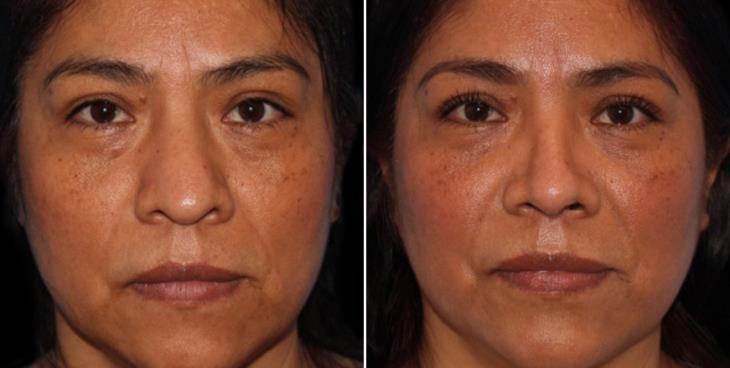 Results Of Open Rhinoplasty In Atlanta